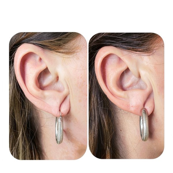 Lobe Wonder Earring Support Patches Hypoallergenic Earlobe-2